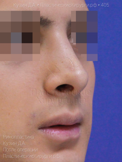 ринопластика, пластический хирург Кузин Д. А., результат №405, ракурс 2, фото после операции