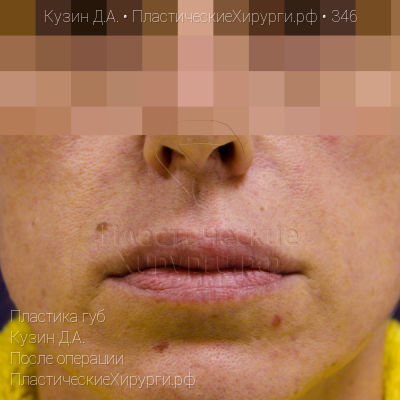 пластика губ, пластический хирург Кузин Д. А., результат №346, ракурс 1, фото после операции