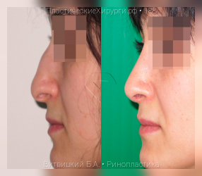 ринопластика, результат №188, предварительное изображение до и после операции
