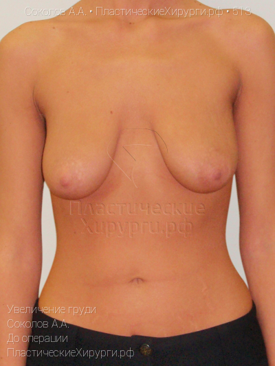 увеличение груди, пластический хирург Соколов А. А., результат №513, ракурс 1, фото до операции
