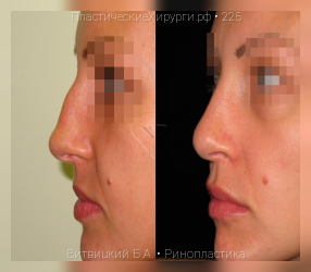 ринопластика, результат №225, предварительное изображение до и после операции