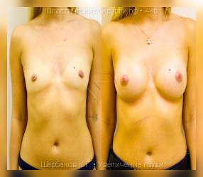 увеличение груди, результат №436, предварительное изображение до и после операции
