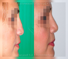 ринопластика, результат №141, предварительное изображение до и после операции