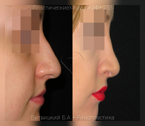 ринопластика, результат №233, предварительное изображение до и после операции