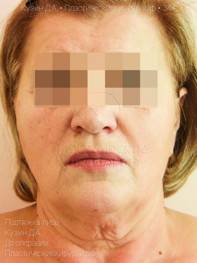 подтяжка лица, пластический хирург Кузин Д. А., результат №344, ракурс 1, фото до операции