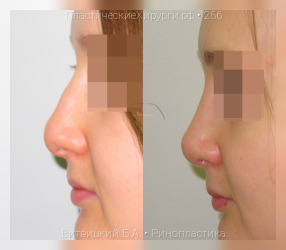 ринопластика, результат №256, предварительное изображение до и после операции