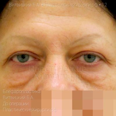 блефаропластика, пластический хирург Витвицкий Б. А., результат №12, ракурс 1, фото до операции