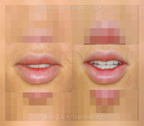 пластика губ, результат №345, предварительное изображение до и после операции