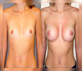 увеличение груди, результат №87, предварительное изображение до и после операции