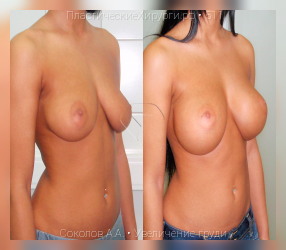 увеличение груди, результат №511, предварительное изображение до и после операции