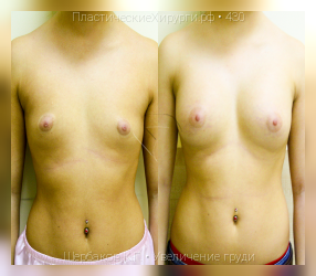 увеличение груди, результат №430, предварительное изображение до и после операции