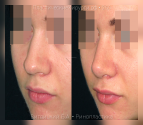 ринопластика, результат №250, предварительное изображение до и после операции