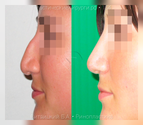 ринопластика, результат №154, предварительное изображение до и после операции