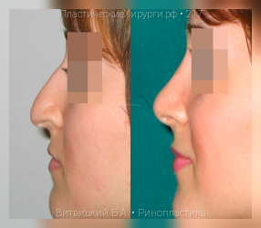ринопластика, результат №217, предварительное изображение до и после операции