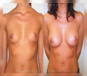 увеличение груди, результат №74, предварительное изображение до и после операции