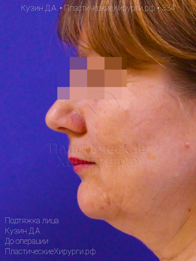 подтяжка лица, пластический хирург Кузин Д. А., результат №334, ракурс 5, фото до операции