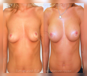 увеличение груди, результат №73, предварительное изображение до и после операции