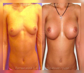 увеличение груди, результат №100, предварительное изображение до и после операции