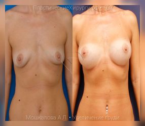 увеличение груди, результат №500, предварительное изображение до и после операции