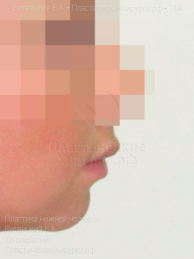 пластика нижней челюсти, пластический хирург Витвицкий Б. А., результат №114, ракурс 3, фото до операции
