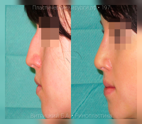 ринопластика, результат №197, предварительное изображение до и после операции