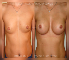 увеличение груди, результат №96, предварительное изображение до и после операции