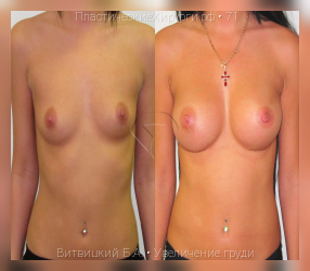 увеличение груди, результат №71, предварительное изображение до и после операции