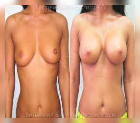увеличение груди, результат №70, предварительное изображение до и после операции