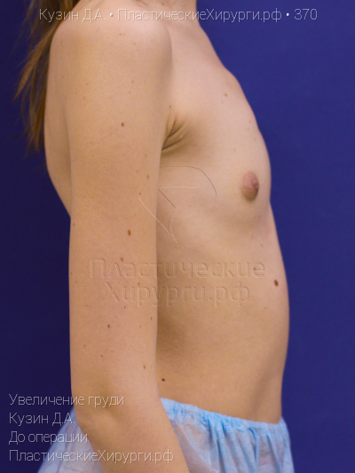 увеличение груди, пластический хирург Кузин Д. А., результат №370, ракурс 3, фото до операции