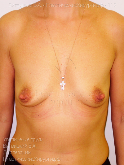 увеличение груди, пластический хирург Витвицкий Б. А., результат №112, ракурс 1, фото до операции