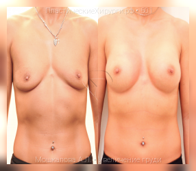увеличение груди, результат №501, предварительное изображение до и после операции