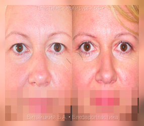 блефаропластика, результат №3, предварительное изображение до и после операции