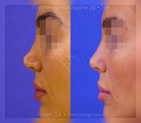 ринопластика, результат №394, предварительное изображение до и после операции