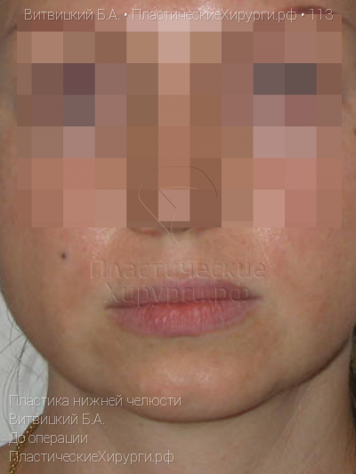 пластика нижней челюсти, пластический хирург Витвицкий Б. А., результат №113, ракурс 1, фото до операции