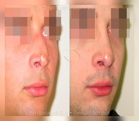 ринопластика, результат №193, предварительное изображение до и после операции