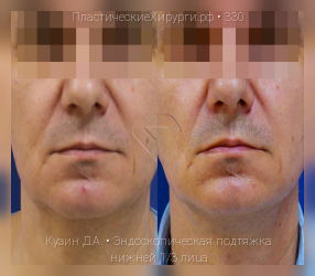 эндоскопическая подтяжка нижней трети лица, результат №330, предварительное изображение до и после операции