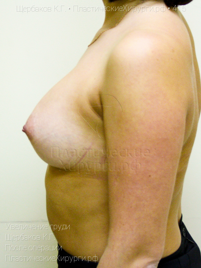 увеличение груди, пластический хирург Щербаков К. Г., результат №415, ракурс 5, фото после операции