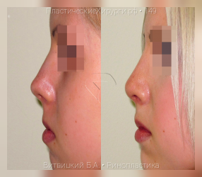 ринопластика, результат №149, предварительное изображение до и после операции