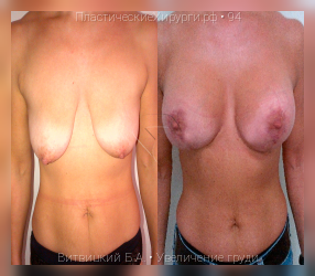 увеличение груди, результат №94, предварительное изображение до и после операции