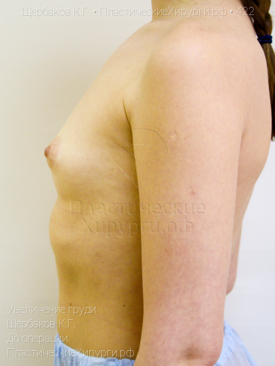 увеличение груди, пластический хирург Щербаков К. Г., результат №422, ракурс 5, фото до операции