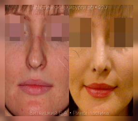 ринопластика, результат №220, предварительное изображение до и после операции