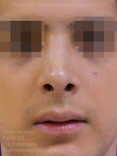 ринопластика, пластический хирург Кузин Д. А., результат №405, ракурс 1, фото после операции