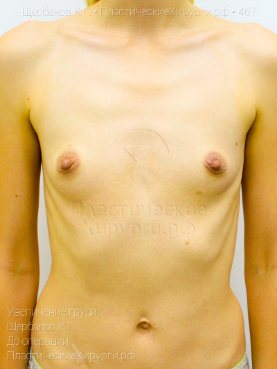 увеличение груди, пластический хирург Щербаков К. Г., результат №467, ракурс 1, фото до операции
