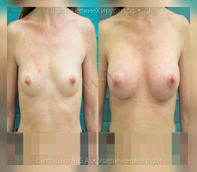 увеличение груди, результат №79, предварительное изображение до и после операции