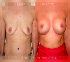 увеличение груди, результат №105, предварительное изображение до и после операции