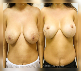 подтяжка груди, результат №472, предварительное изображение до и после операции