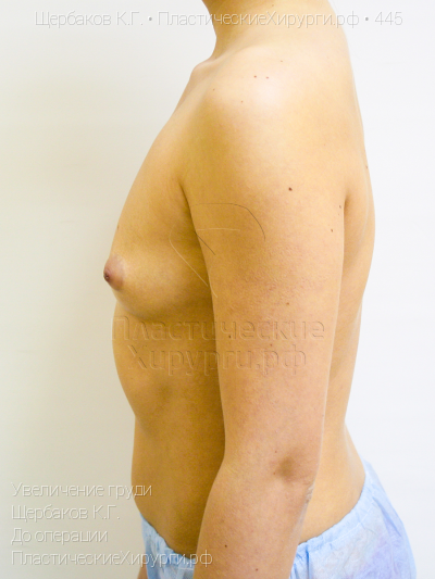 увеличение груди, пластический хирург Щербаков К. Г., результат №445, ракурс 5, фото до операции