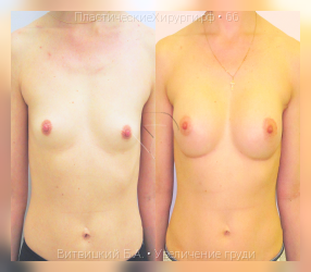 увеличение груди, результат №66, предварительное изображение до и после операции