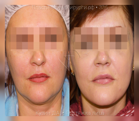 подтяжка лица, результат №335, предварительное изображение до и после операции