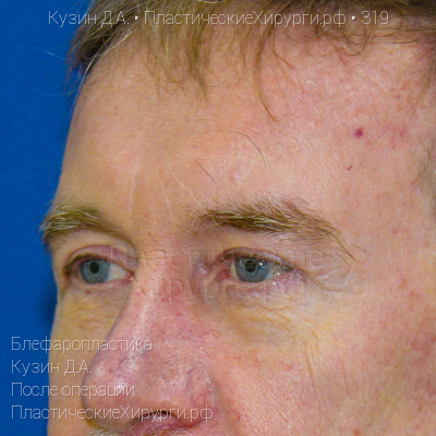 блефаропластика, пластический хирург Кузин Д. А., результат №319, ракурс 2, фото после операции